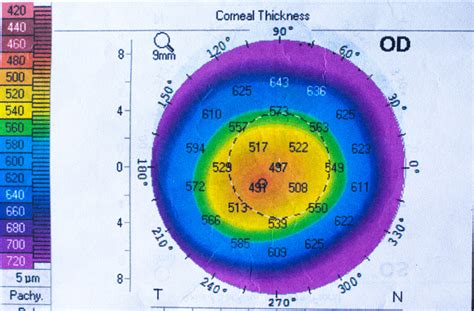 cpt code for pachymetric cornea